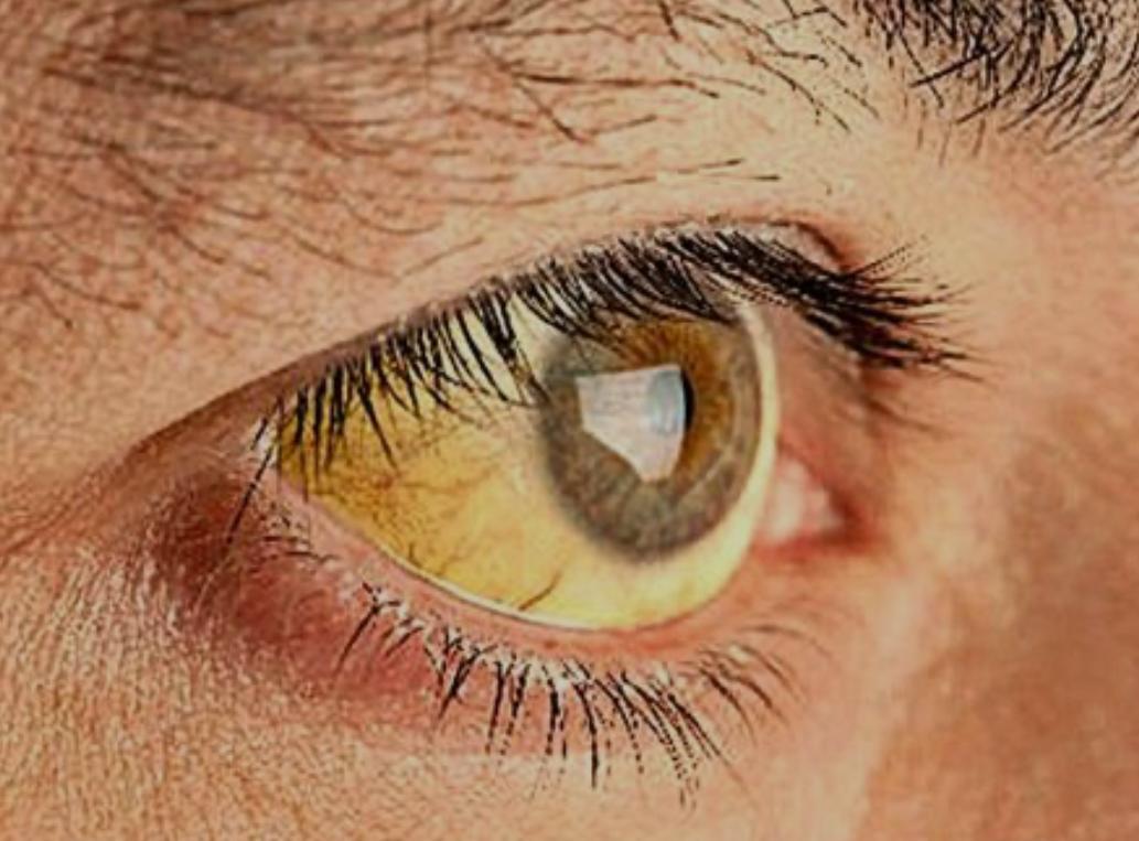Color amarillo en los ojos